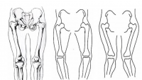 Diagram of normal leg alignment, bowlegs and knock knees